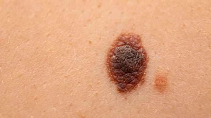 Khawatir Punya Gejala Kanker Melanoma